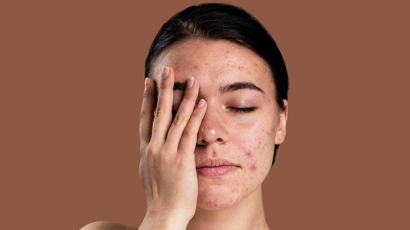 How to Get Rid of Acne Scars