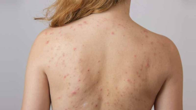 How to Get Rid of Back Acne