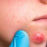 How to Get Rid of Boils: Causes, Natural Treatments
