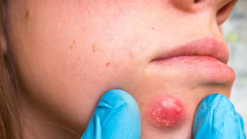 How to Get Rid of Boils: Causes, Natural Treatments