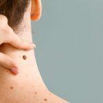 Seborrheic Keratosis Overview